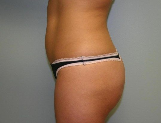 Body Contouring Before & After