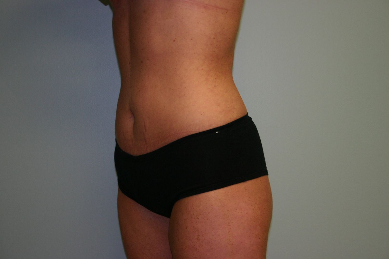 Body Contouring Before & After