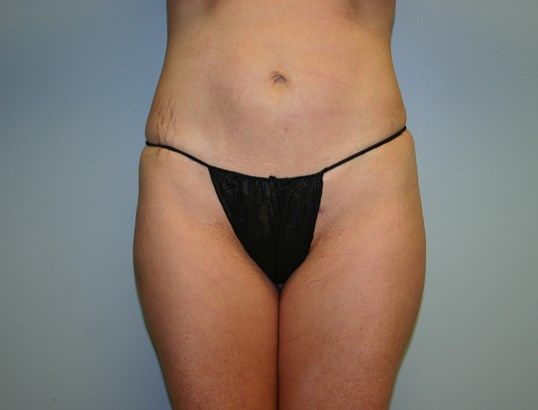Body Contouring Before & After