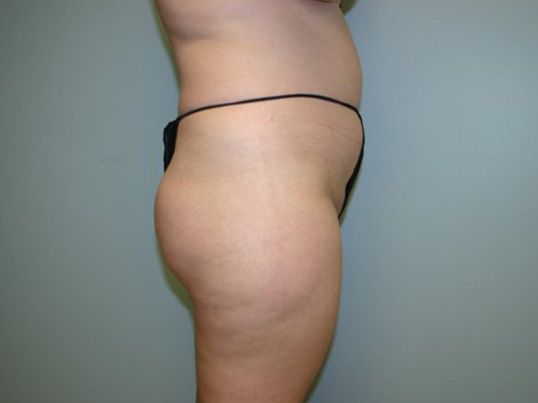 Body Contouring Before & After
