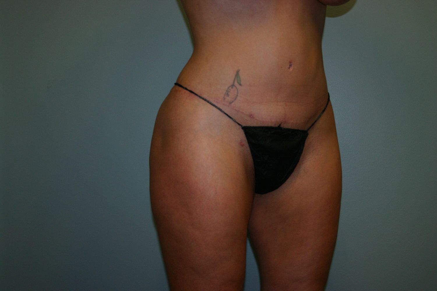 Body Contouring Before & After