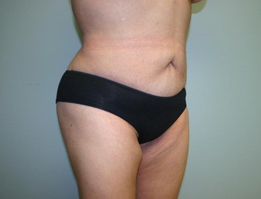 Body Contouring Before & After