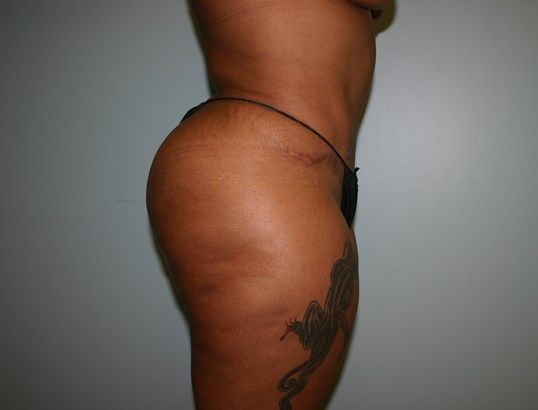 Body Contouring Before & After