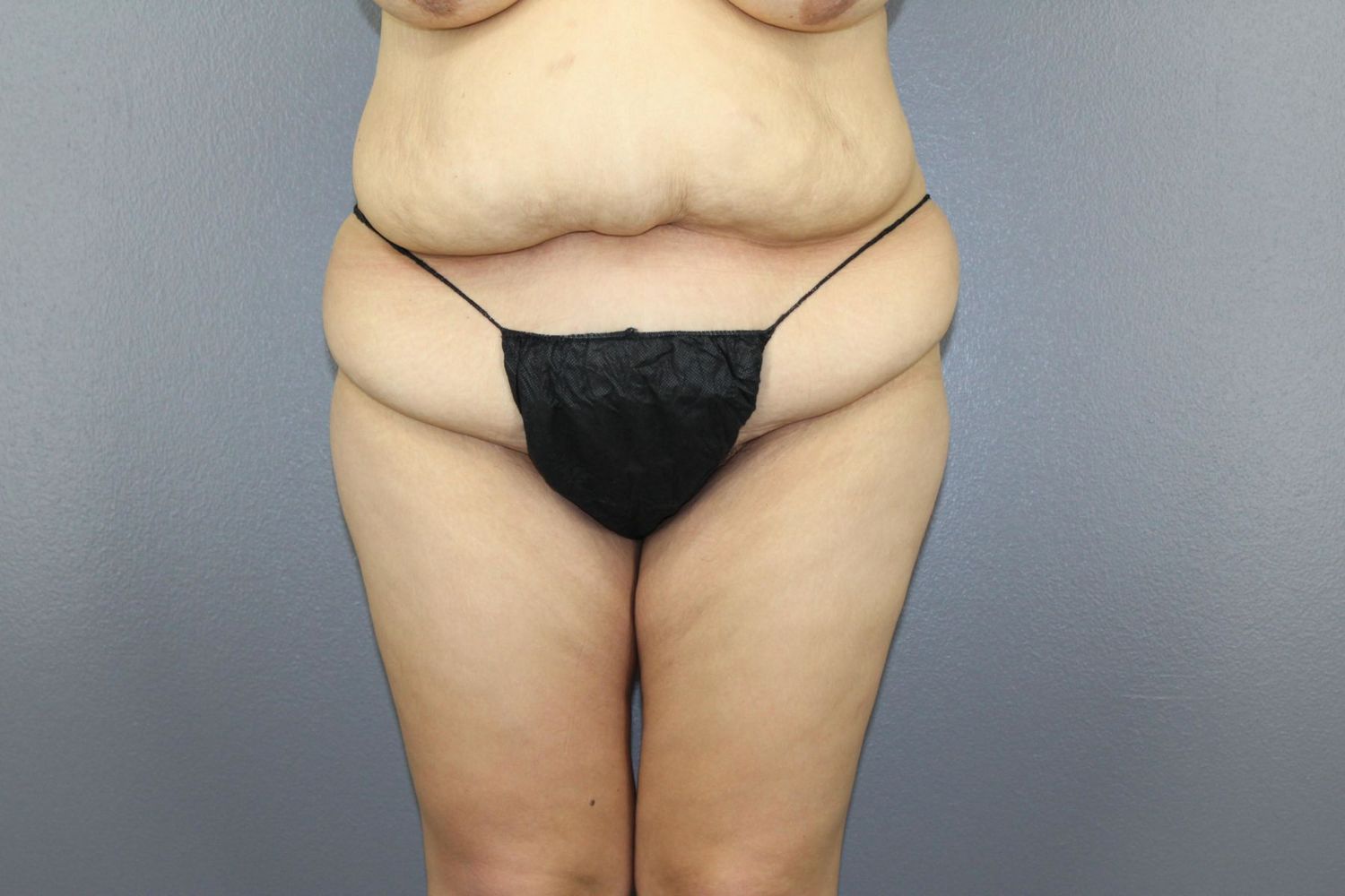 Body Contouring Before & After