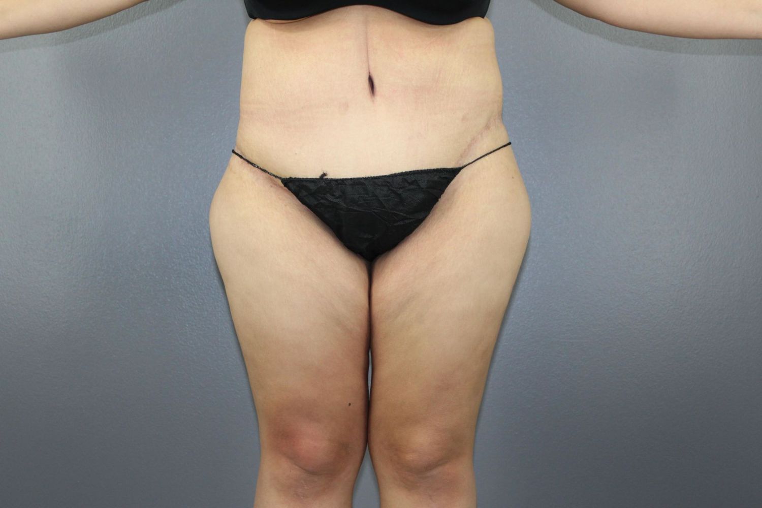 Body Contouring Before & After