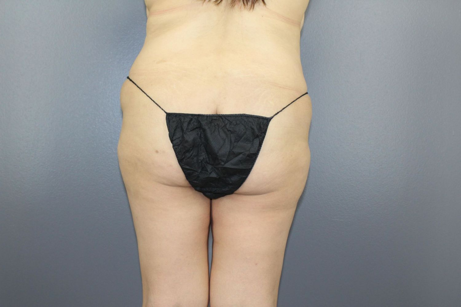 Body Contouring Before & After