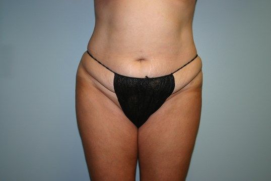 Body Contouring Before & After