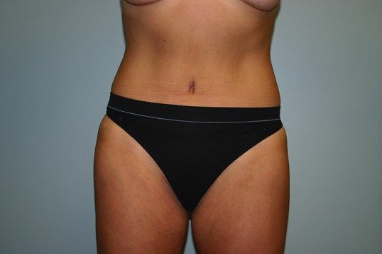 Body Contouring Before & After