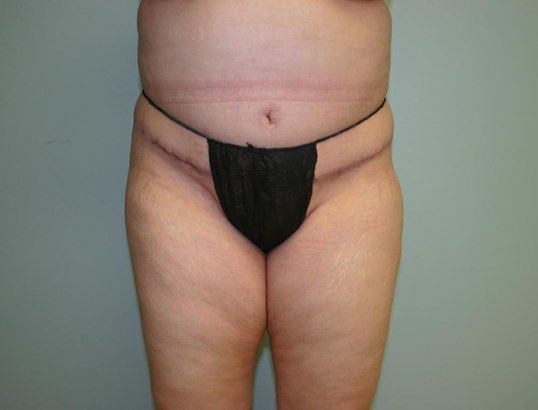 Body Contouring Before & After