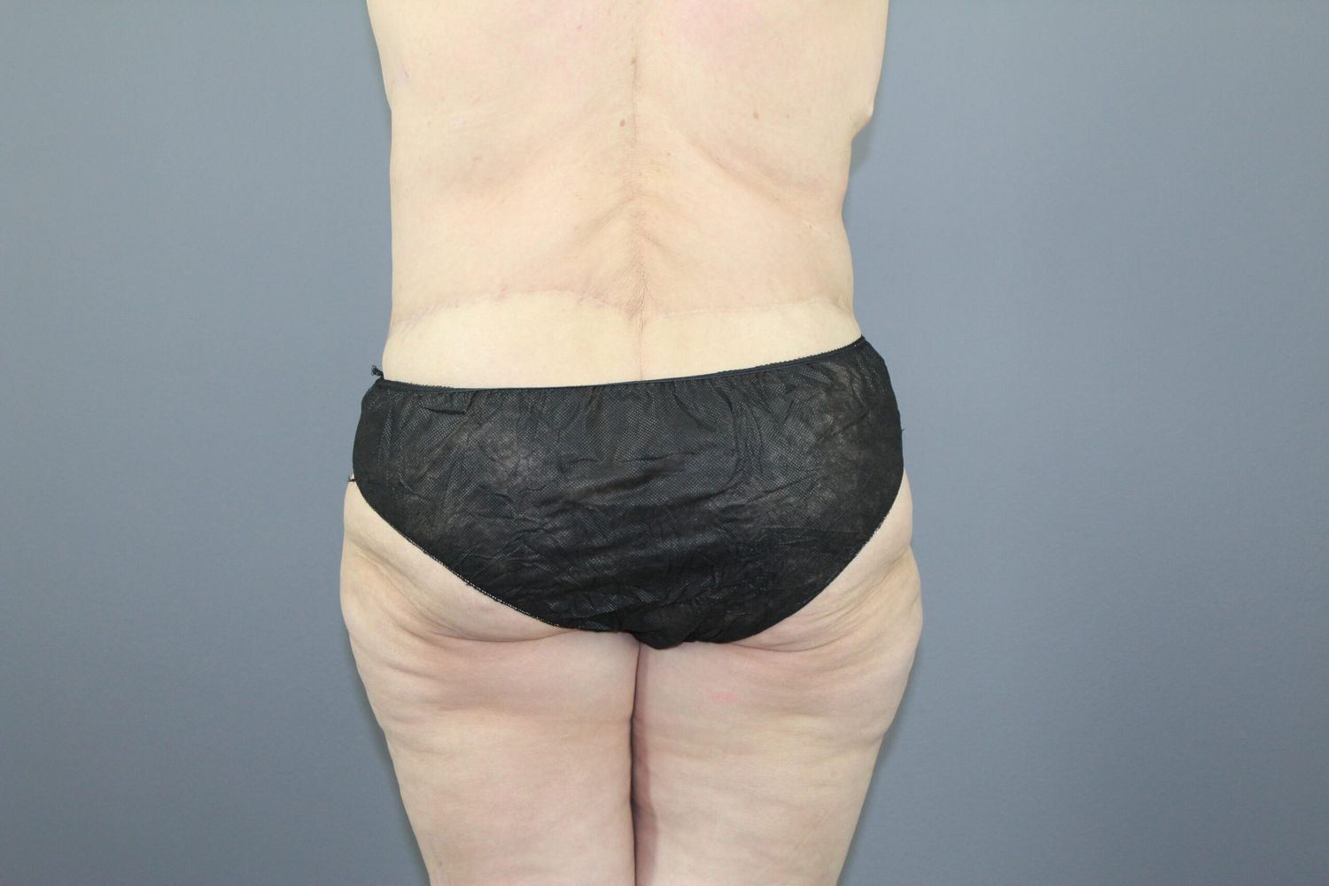 Body Contouring Before & After