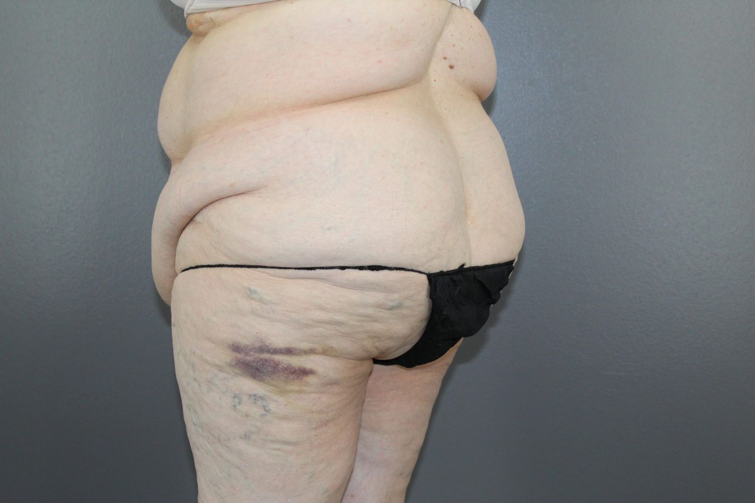 Body Contouring Before & After