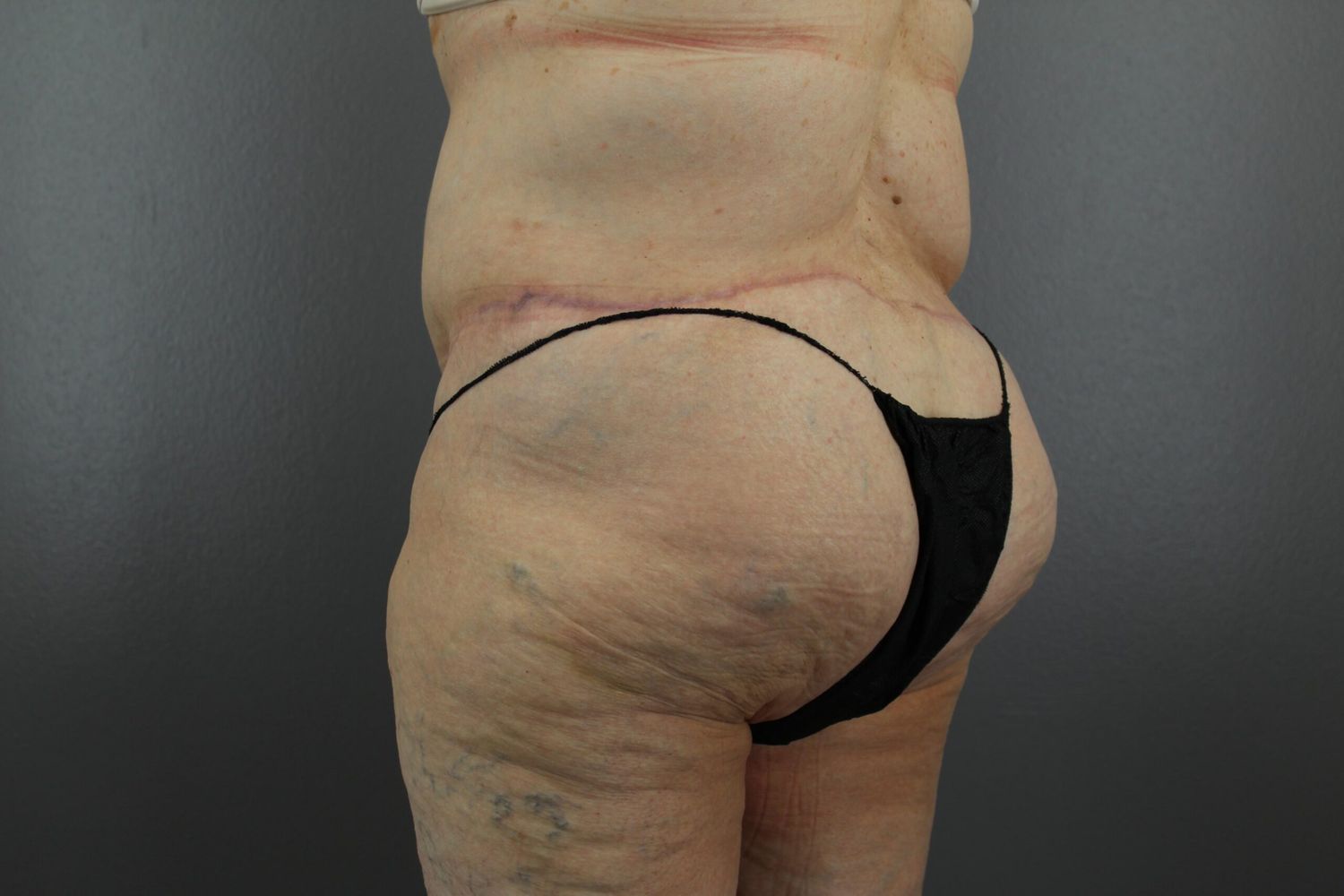 Body Contouring Before & After