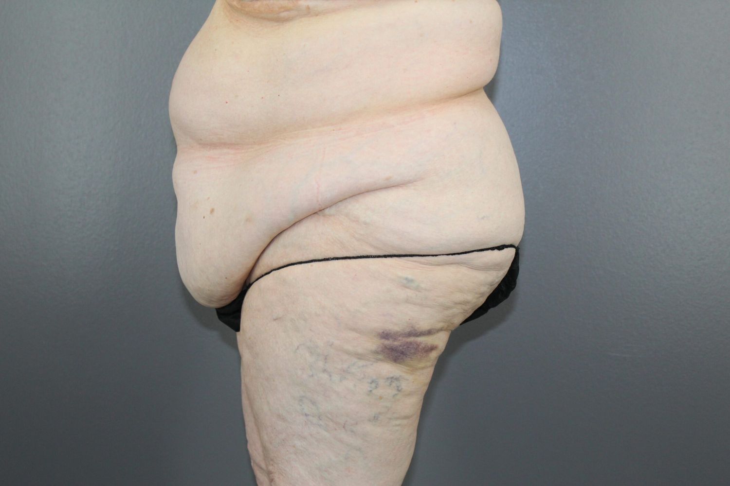 Body Contouring Before & After