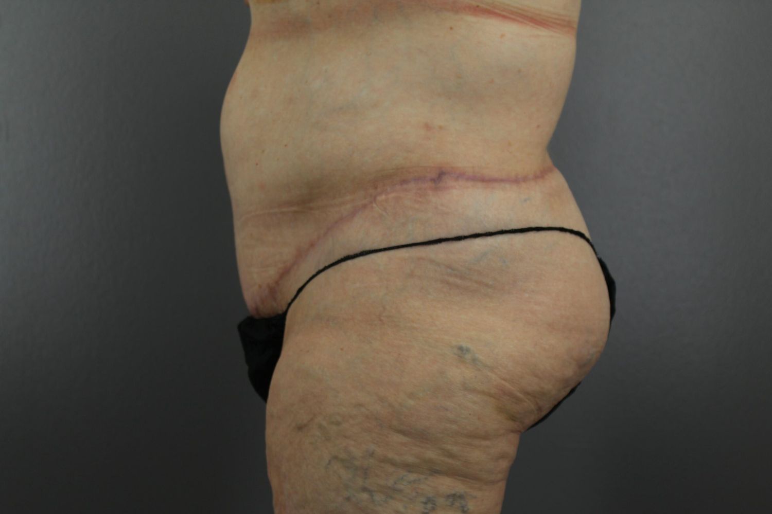 Body Contouring Before & After