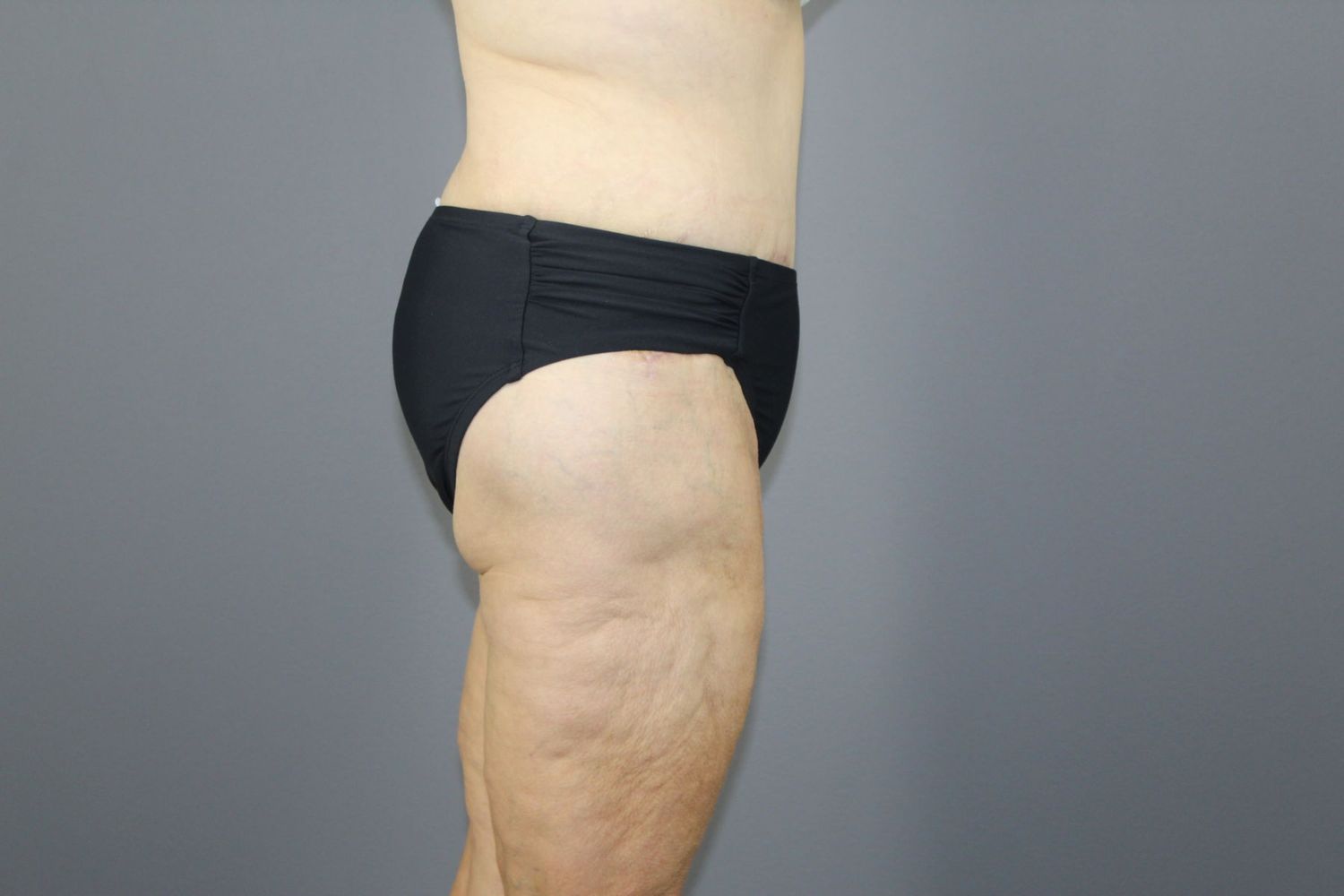 Body Contouring Before & After