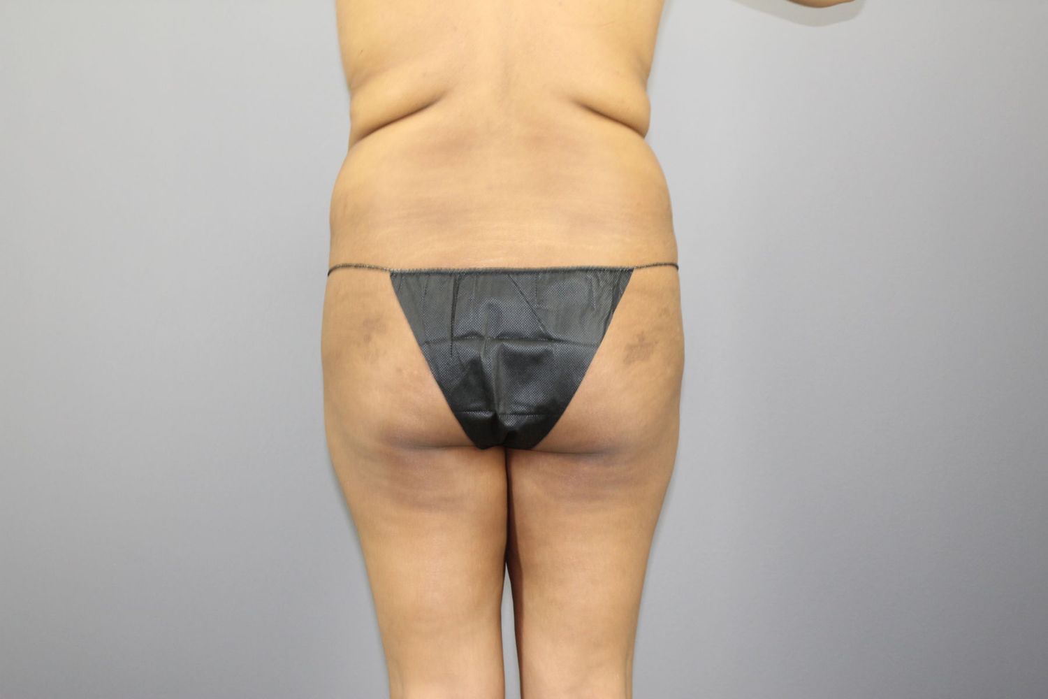 Body Contouring Before & After