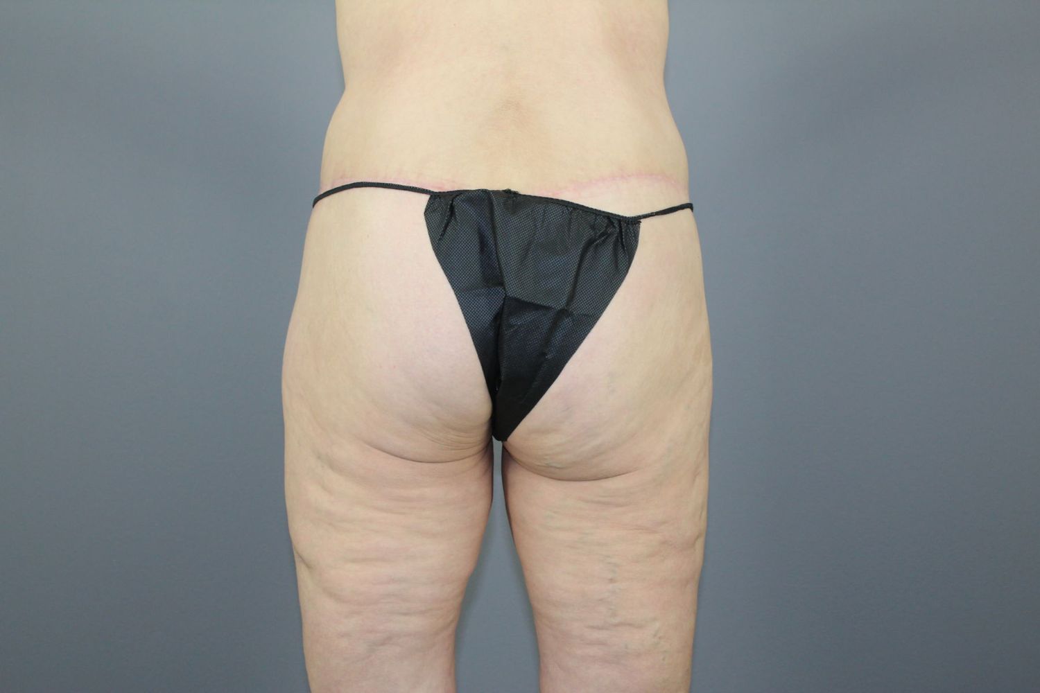 Body Contouring Before & After