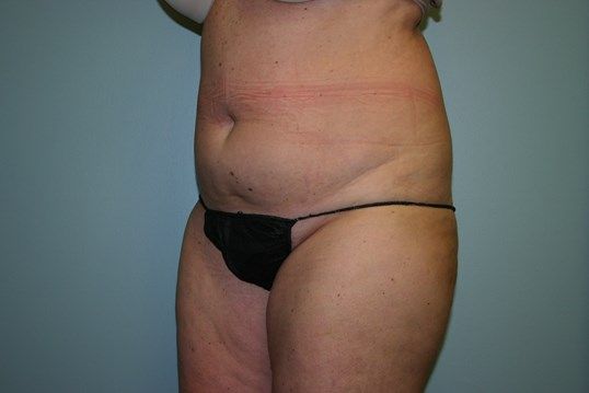 Body Contouring Before & After