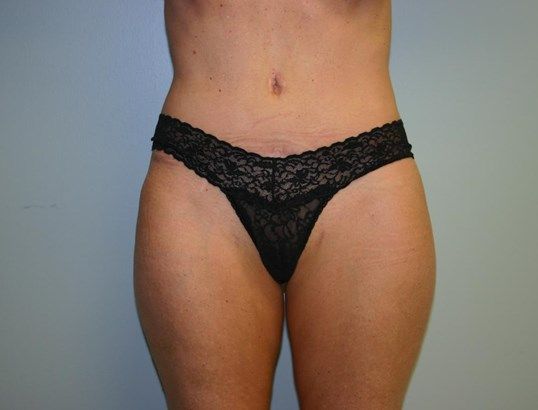 Body Contouring Before & After