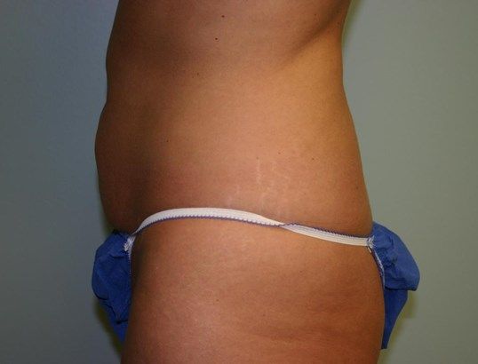 Body Contouring Before & After