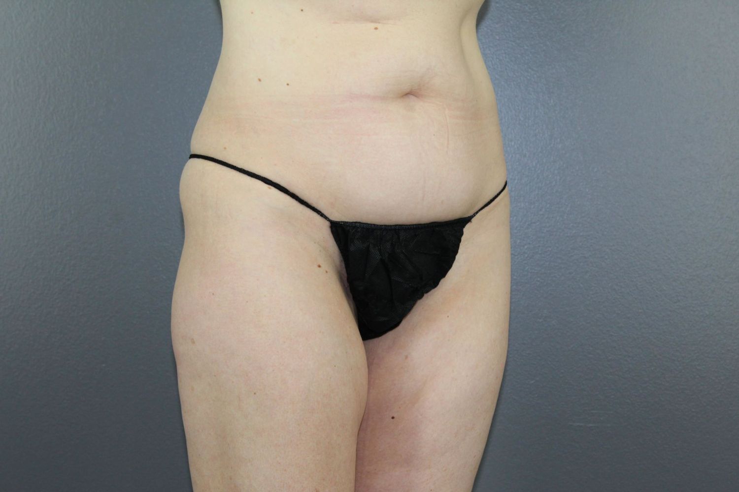 Body Contouring Before & After