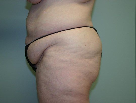 Body Contouring Before & After