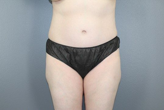 Body Contouring Before & After