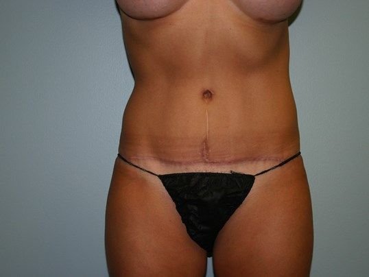 Body Contouring Before & After