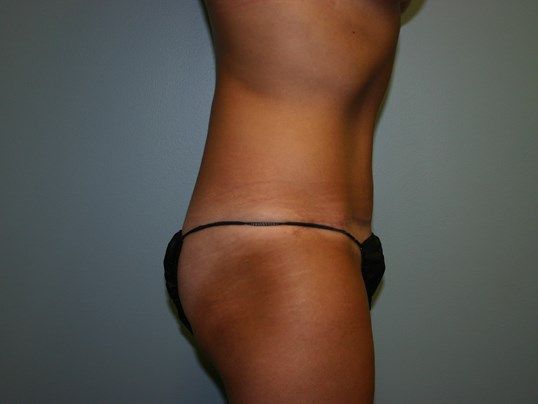 Body Contouring Before & After