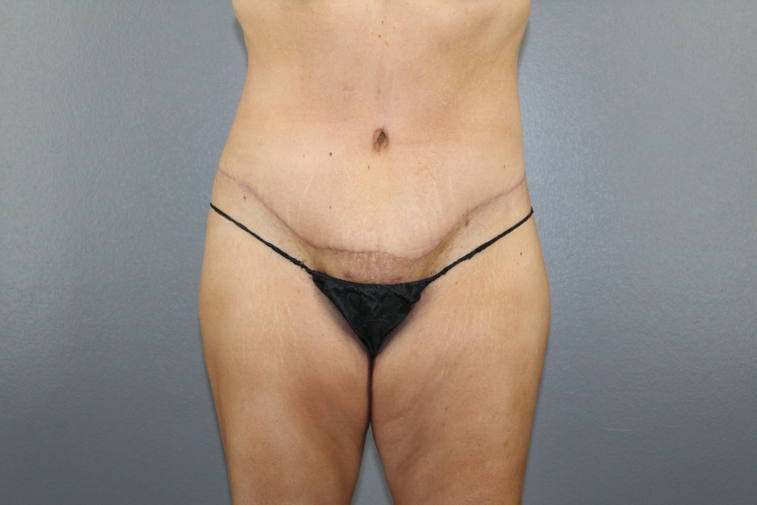 Body Contouring Before & After
