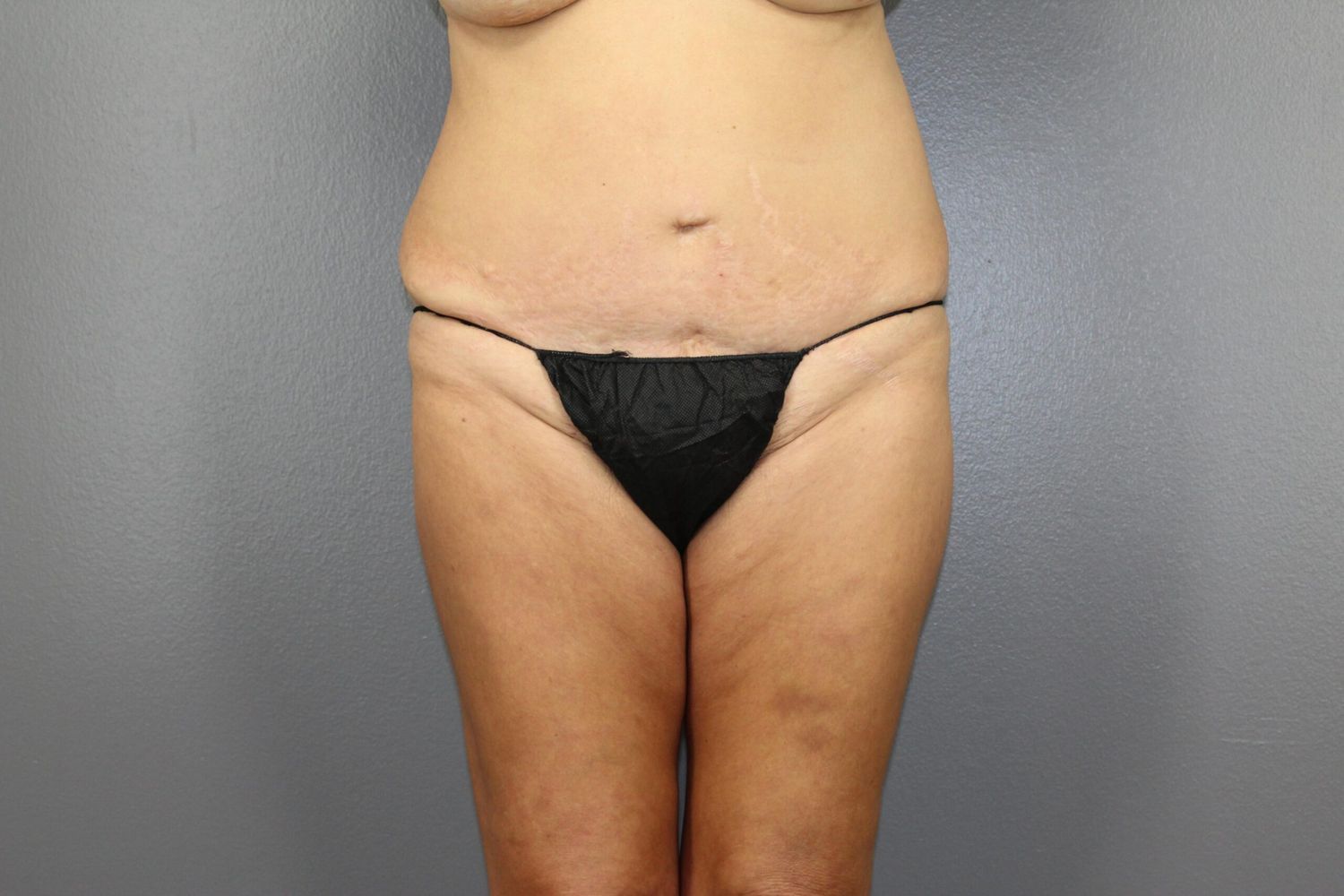 Body Contouring Before & After