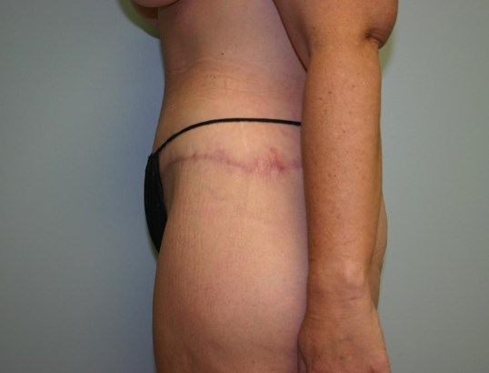 Body Contouring Before & After