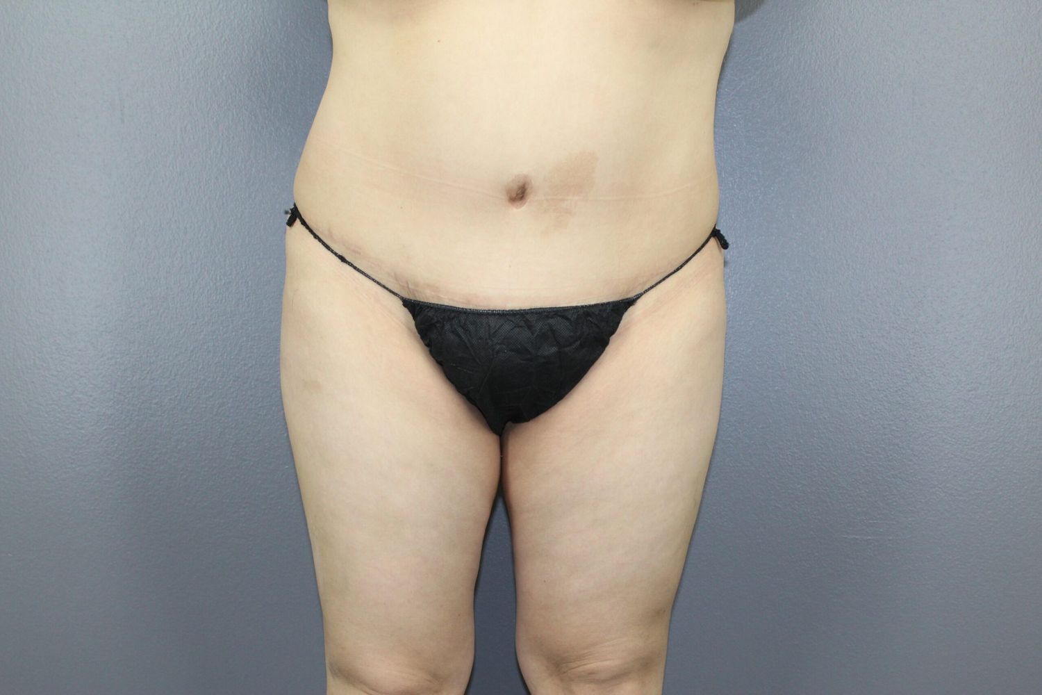 Body Contouring Before & After