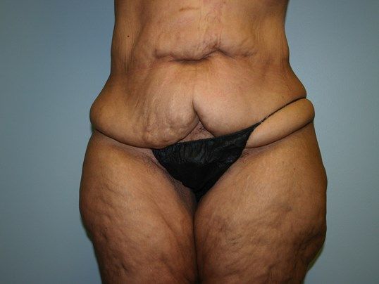 Body Contouring Before & After