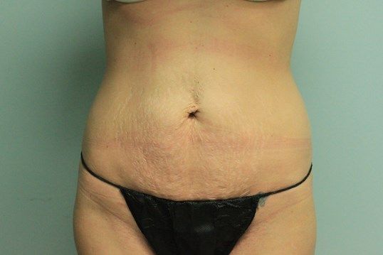 Body Contouring Before & After