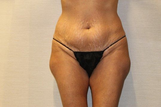 Body Contouring Before & After