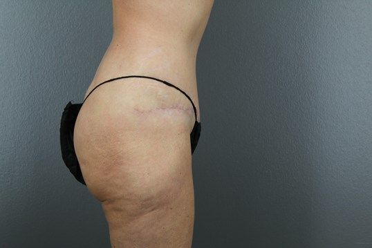 Body Contouring Before & After