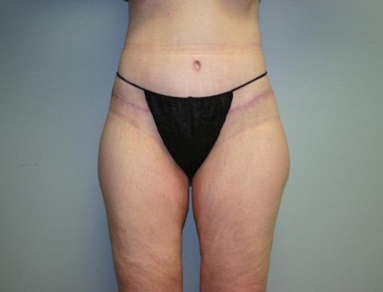 Body Contouring Before & After