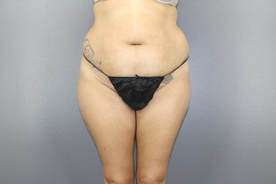 Body Contouring Before & After