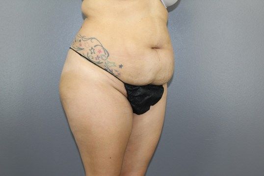 Body Contouring Before & After