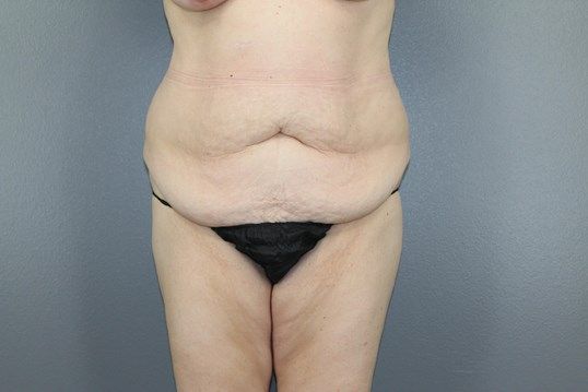 Body Contouring Before & After