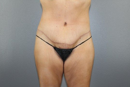 Body Contouring Before & After