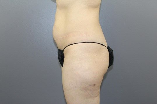 Body Contouring Before & After