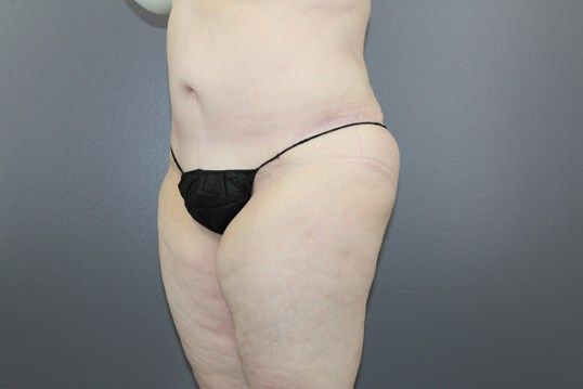 Body Contouring Before & After