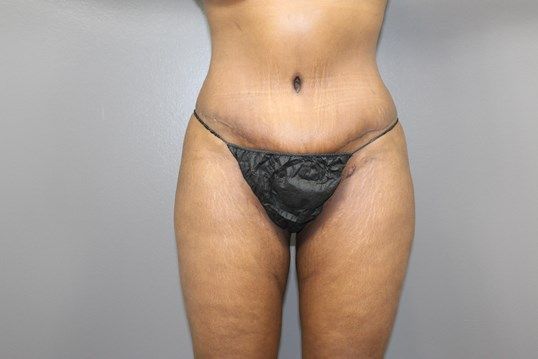 Body Contouring Before & After
