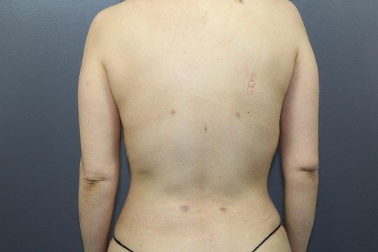 Body Contouring Before & After