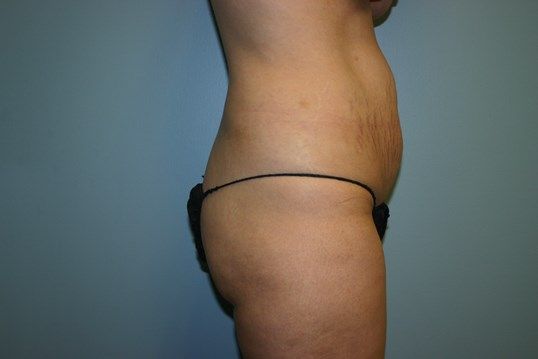 Body Contouring Before & After