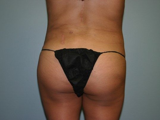 Body Contouring Before & After