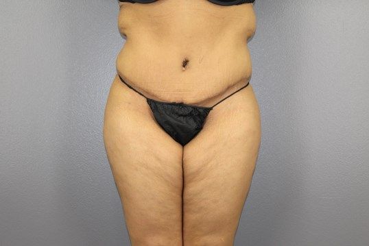 Body Contouring Before & After
