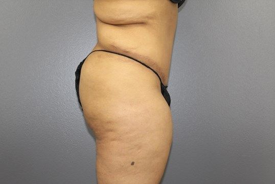 Body Contouring Before & After